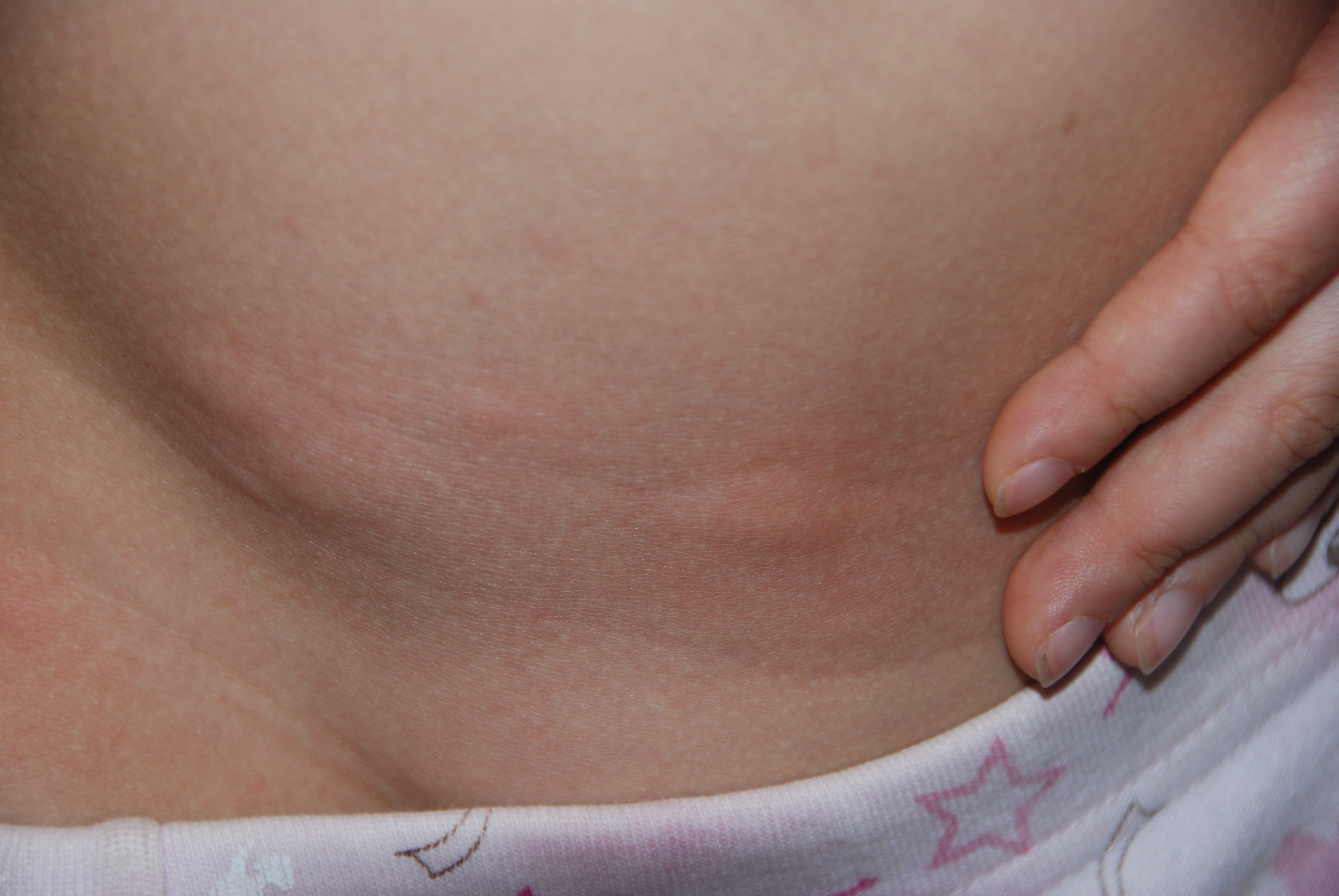 What do hives (urticaria) look like? - WebMD Answers